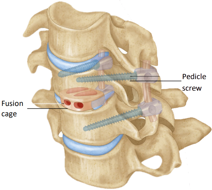 Fig. 1 –Anterior Cervical Discectomy & Fusion