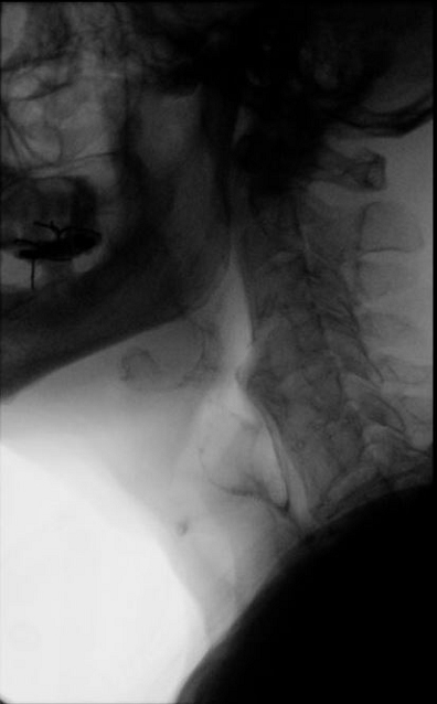 Fig. 1 –Cervical Osteophyte on Video-fluoroscopy