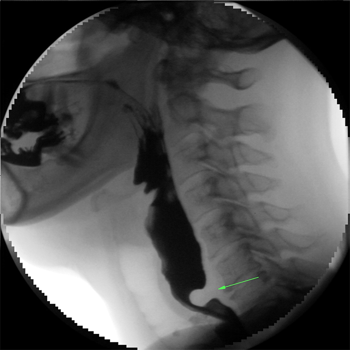 Fig. 1 –Cricopharyngeal bar on Video-fluoroscopy