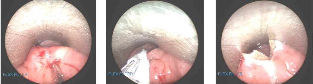 Fig. 3-5 –Endoscopic Zenker’s Diverticulostomyusing ENSEAL®Device.