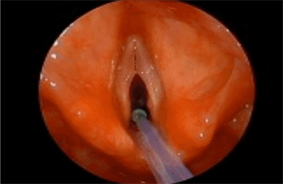 Operative view of the vocal cords at microlaryngoscopy