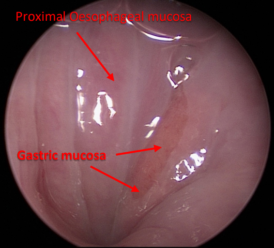Fig. 1 – heterotopic gastric mucosa